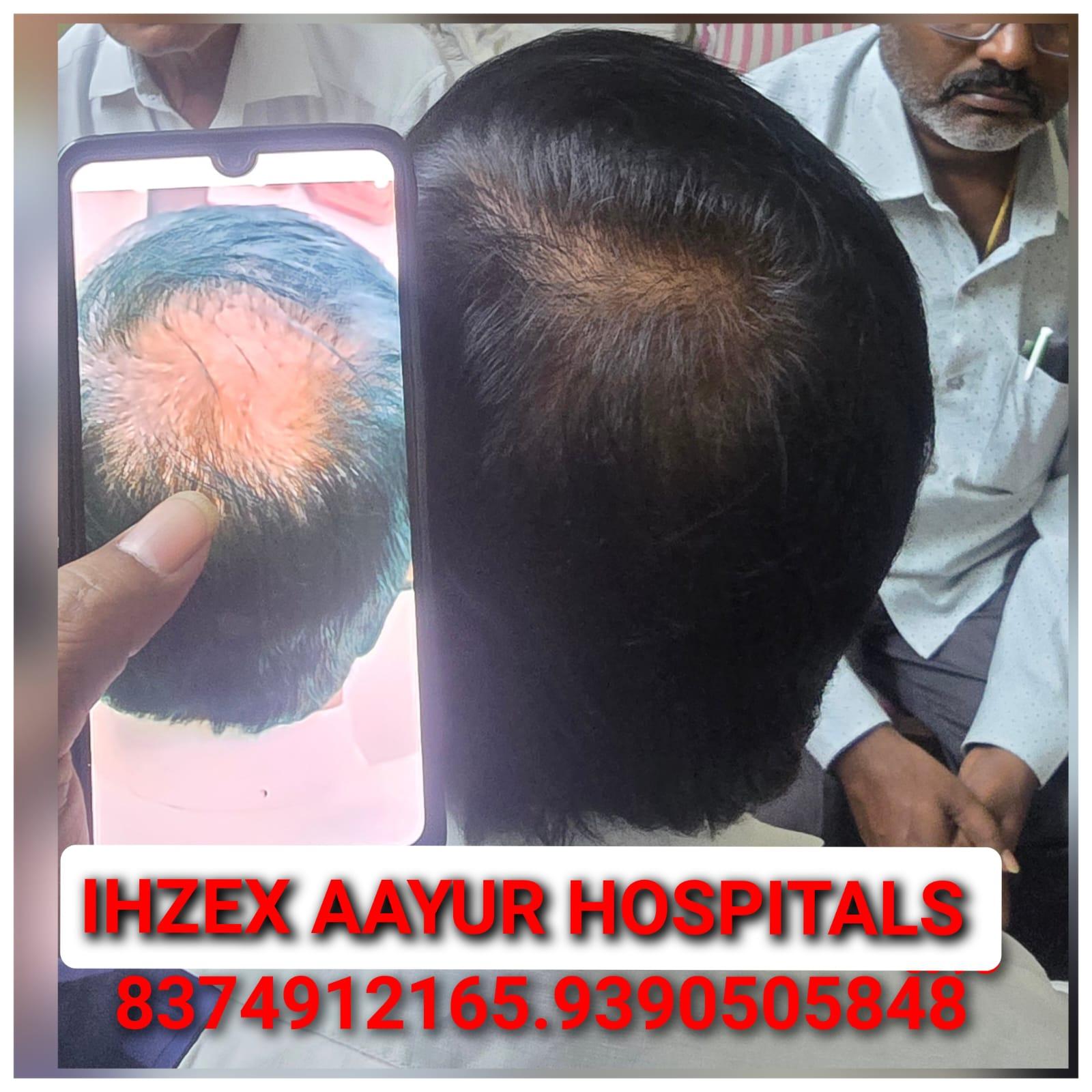 Hair Recovery Result 1